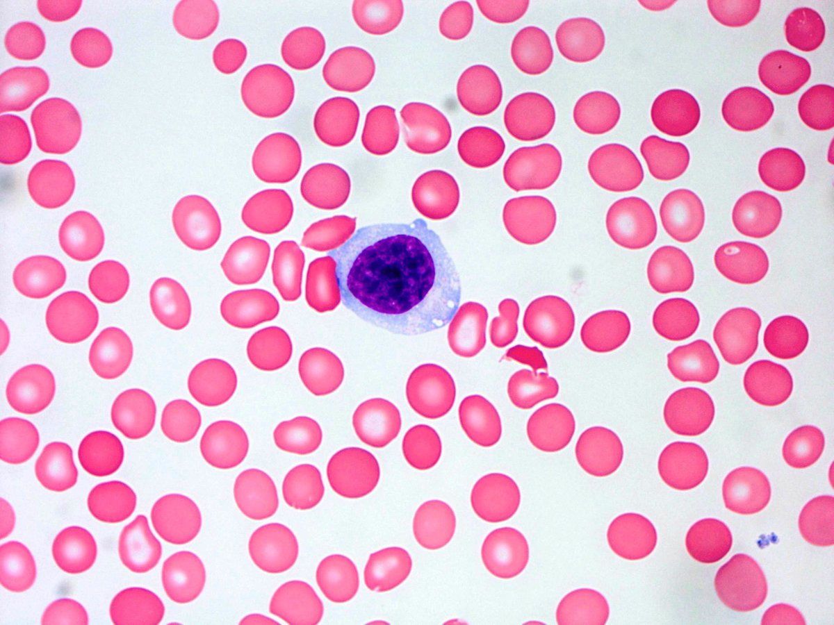 Peripheral blood with circulating atypical large granular lymphoid cells (Wright Giemsa, 1000x)